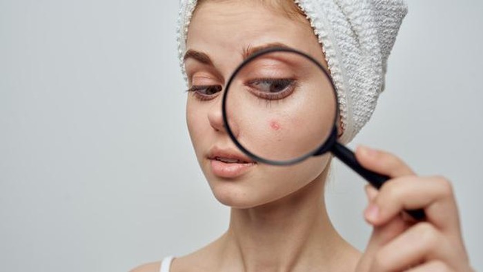 Awas Muncul Blind Pimple! Begini Cara Mengatasinya