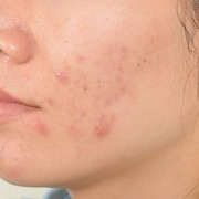 Beda dengan Breakout, Ini Cara Mengatasi Kulit Purging