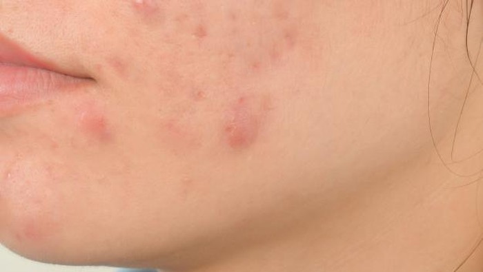 Beda dengan Breakout, Ini Cara Mengatasi Kulit Purging