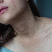 Cara Tepat Mengatasi Eksim Agar Nyaman dan Tidak Gatal Lagi