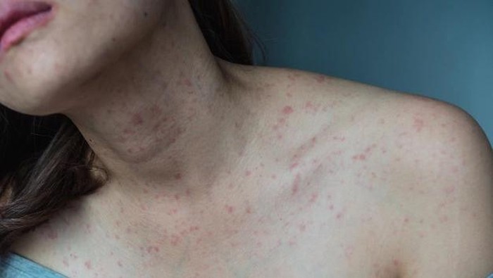 Cara Tepat Mengatasi Eksim Agar Nyaman dan Tidak Gatal Lagi