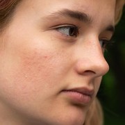 Ketahui 5 Alasan yang Membuat Wajah Kamu Breakout