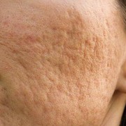 Bekas Jerawat Sering Jadi Bopeng? Cek Dulu Penyebabnya