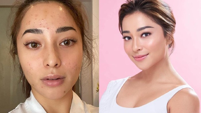 Cerita Nikita Willy Wajah Penuh Jerawat, Nangis Tiap Malam