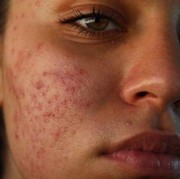 Jenis-jenis Jerawat dan Cara Mengatasinya