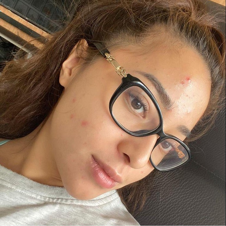 Nikita Willy sempat enggan syuting karena wajahnya dipenuhi oleh jerawat beberapa waktu lalu. Yuk kita lihat bagaimana penampakan wajah Nikita Willy yang penuh jerawat!