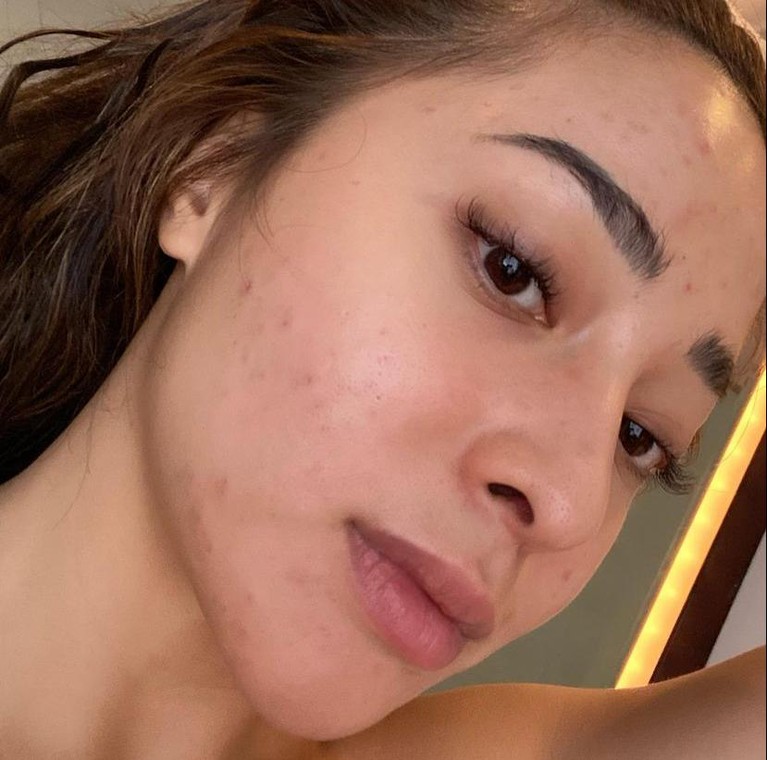 Nikita Willy Nikita Willy sempat enggan syuting karena wajahnya dipenuhi oleh jerawat beberapa waktu lalu. Yuk kita lihat bagaimana penampakan wajah Nikita Willy yang penuh jerawat!