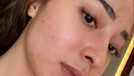 Nikita Willy sempat enggan syuting karena wajahnya dipenuhi oleh jerawat beberapa waktu lalu&period; Yuk kita lihat bagaimana penampakan wajah Nikita Willy yang penuh jerawat&excl;