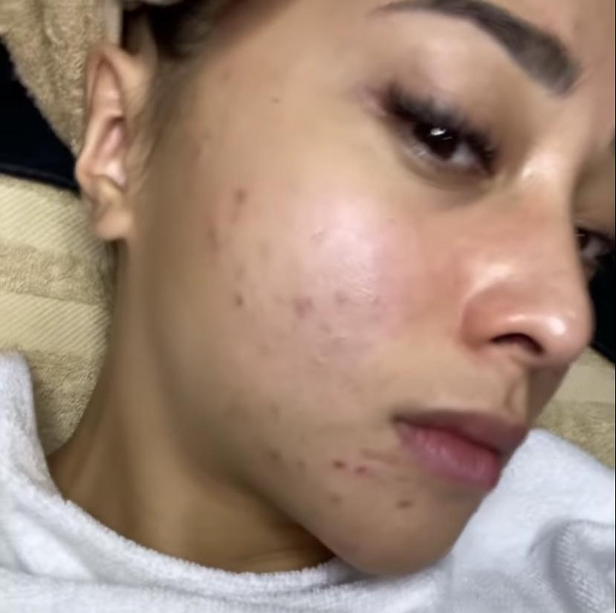 Nikita Willy sempat enggan syuting karena wajahnya dipenuhi oleh jerawat beberapa waktu lalu&period; Yuk kita lihat bagaimana penampakan wajah Nikita Willy yang penuh jerawat&excl;