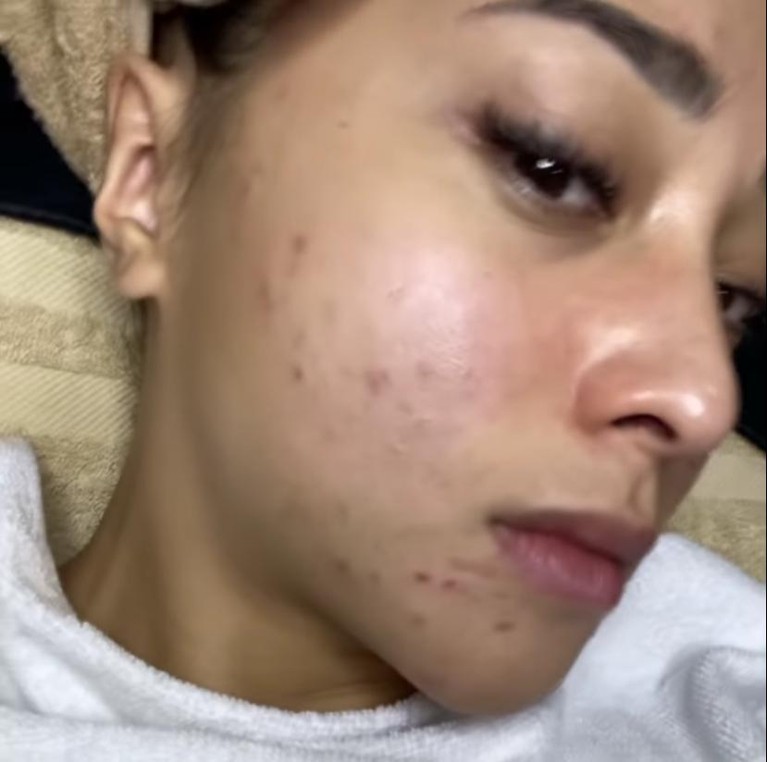 Nikita Willy Nikita Willy sempat enggan syuting karena wajahnya dipenuhi oleh jerawat beberapa waktu lalu. Yuk kita lihat bagaimana penampakan wajah Nikita Willy yang penuh jerawat!