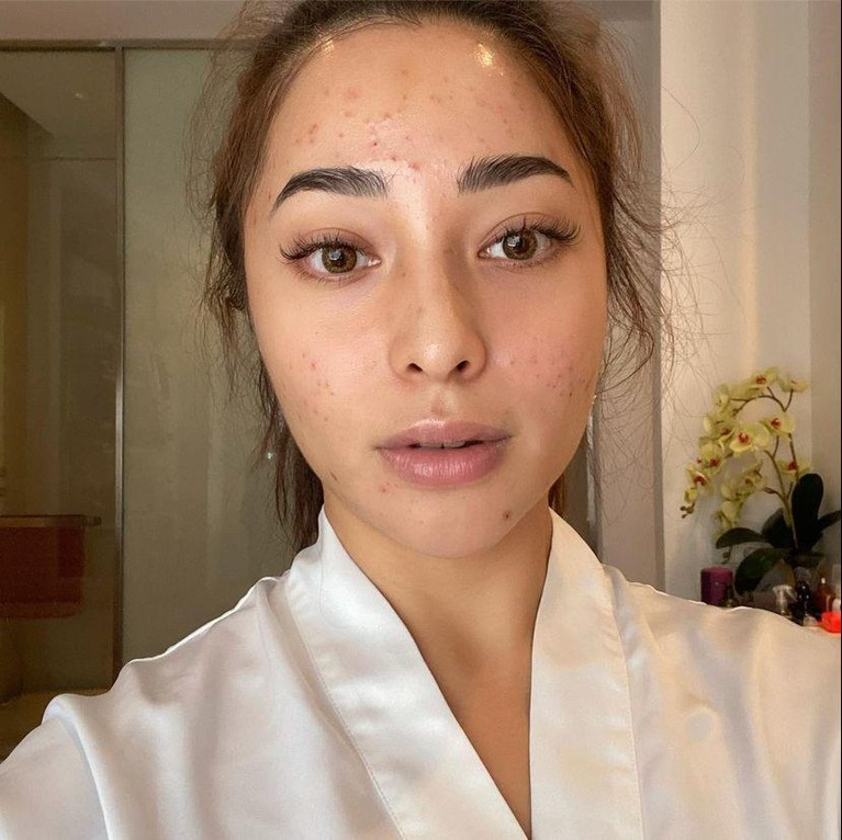 Nikita Willy sempat enggan syuting karena wajahnya dipenuhi oleh jerawat beberapa waktu lalu. Yuk kita lihat bagaimana penampakan wajah Nikita Willy yang penuh jerawat!