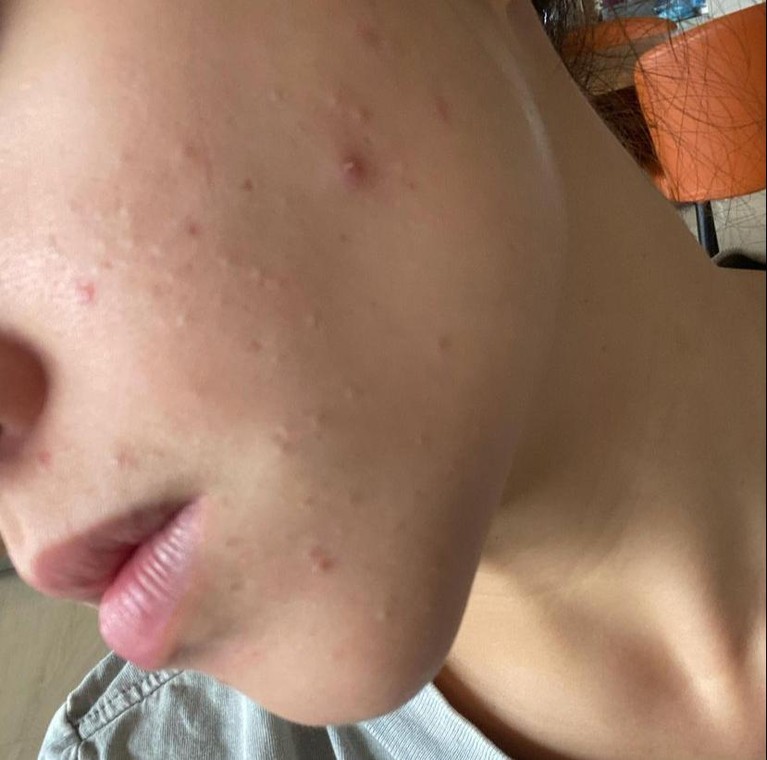 Nikita Willy Nikita Willy sempat enggan syuting karena wajahnya dipenuhi oleh jerawat beberapa waktu lalu. Yuk kita lihat bagaimana penampakan wajah Nikita Willy yang penuh jerawat!