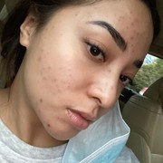 Acne Fighters, Yuk Kenali Tingkat Keparahan Jerawat dan Cara Mengatasinya