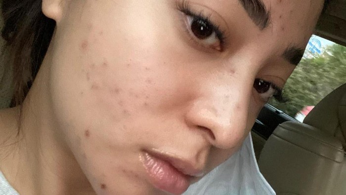 Acne Fighters, Yuk Kenali Tingkat Keparahan Jerawat dan Cara Mengatasinya