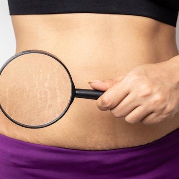 4 Solusi Alami Menghilangkan Stretch Marks untuk Kulit Kembali Mulus