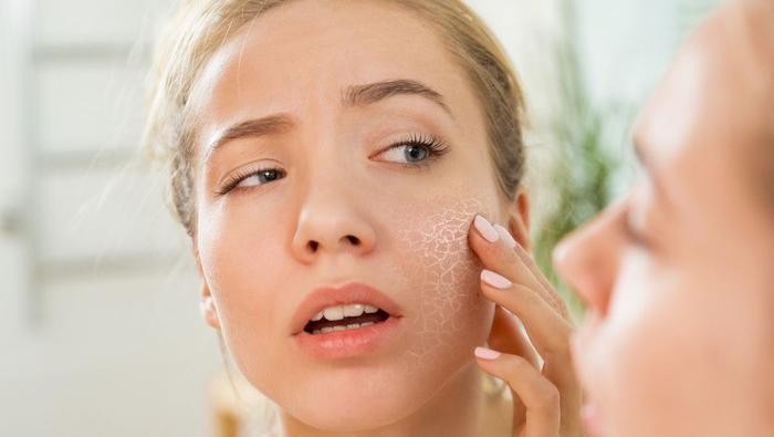 Pernah Mengalami Skin Peeling? Kenali Apa Penyebabnya! Pernah Mengalami Skin Peeling? Kenali Apa Penyebabnya!