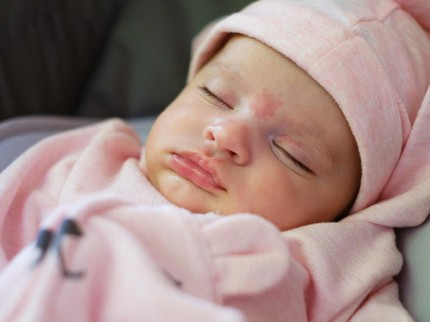 Cara Menghilangkan Tanda Lahir Anak Secara Alami dan Aman Berdasarkan Jenisnya