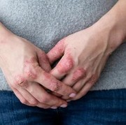 6 Faktor Pemicu Munculnya Eksim