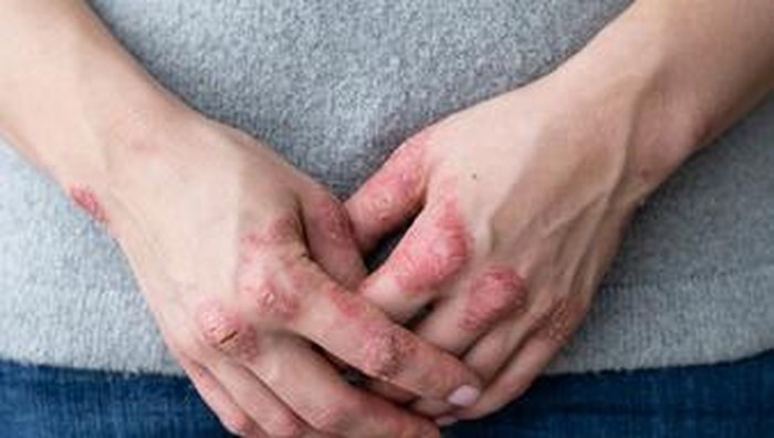 6 Faktor Pemicu Munculnya Eksim 6 Faktor Pemicu Munculnya Eksim