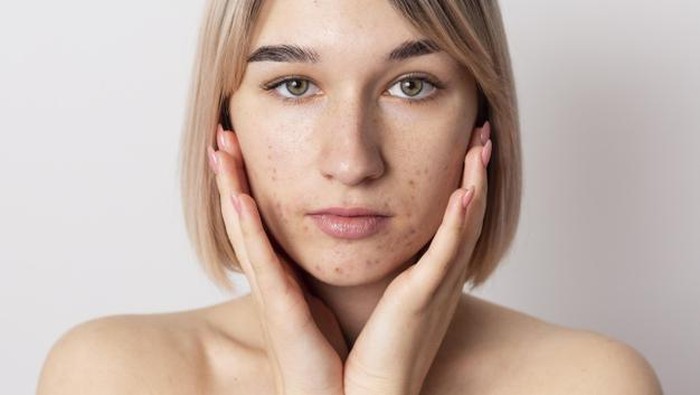 Awas, Inilah 5 Penyebab Munculnya Jerawat di Sekitar Mulut