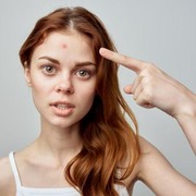 3 Cara Mudah Menutupi Jerawat Tanpa Concealer