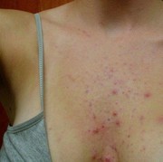 5 Penyebab Jerawat Area Dada yang Wajib Kamu Tahu