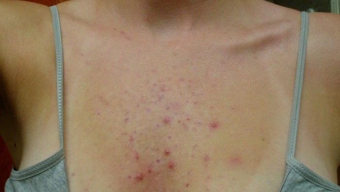 5 Penyebab Jerawat Area Dada yang Wajib Kamu Tahu