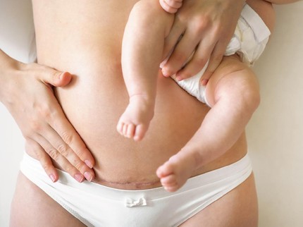 4 Tips Mempercepat Pemulihan Luka Operasi Caesar, Salah Satunya 'Puasa' Seks