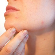 Ketahui 5 Penyebab Jerawatan Setelah Lebaran dan Cara Mengatasinya