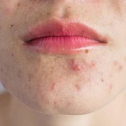 Wajah Breakout Saat Menstruasi? Coba Ikuti 3 Tips Sederhana Berikut Ini untuk Mengatasinya!