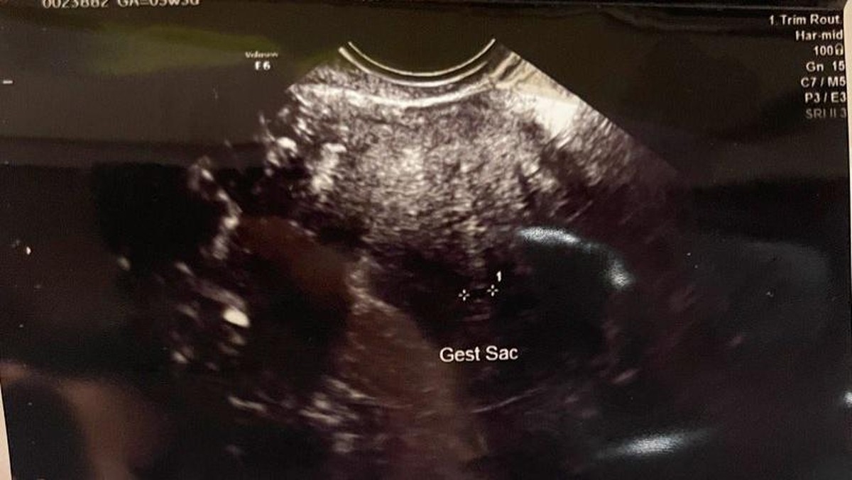 Atta Halilintar dan Aurel Hermansyah sedang berduka karena mengalami keguguran&period; Yuk kita lihat potret tangisan mereka&excl;