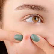 4 Brand Skincare Lokal Ini Mantul Hempas Jerawat