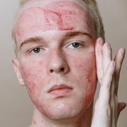 Beres Dalam Sehari, Hempaskan Jerawat dengan 5 Trik Ini!