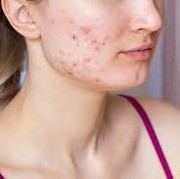 6 Skincare Salicylic Acid Lokal yang Ampuh Mengatasi Jerawat