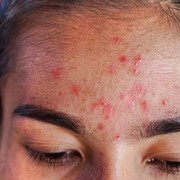 5 Kesalahan Pakai Skincare yang Bikin Kulit Bruntusan