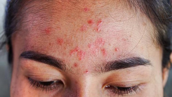 5 Kesalahan Pakai Skincare yang Bikin Kulit Bruntusan