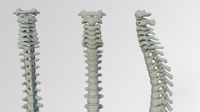 Fakta-Fakta Seputar Lordosis, Ketahui Dampaknya Bagi Kesehatan!