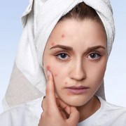 Rekomendasi Toner Lokal untuk Kulit Berjerawat