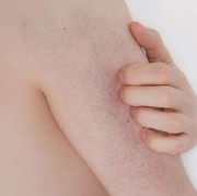 Mengenal Penyakit Kulit Keratosis Pilaris dan Cara Mengatasinya