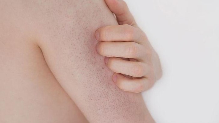 Mengenal Penyakit Kulit Keratosis Pilaris dan Cara Mengatasinya
