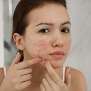 5 Obat Totol Jerawat Favorit Beautynesia di Bawah Rp60 Ribu, Ampuh Redakan Jerawat!