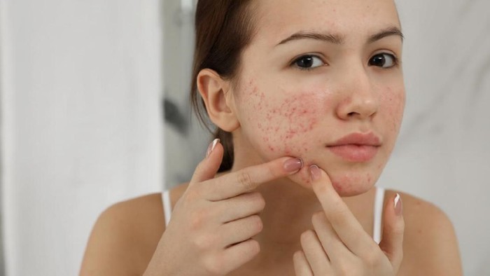 5 Obat Totol Jerawat Favorit Beautynesia di Bawah Rp60 Ribu, Ampuh Redakan Jerawat!