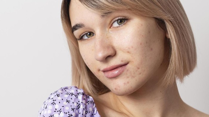 Rekomendasi Primer Hingga Bedak Tabur Untuk Kulit Berjerawat Harga Terjangkau