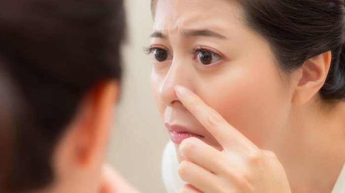 Ini Alasan Kenapa Komedo Putih Muncul Terus-Terusan