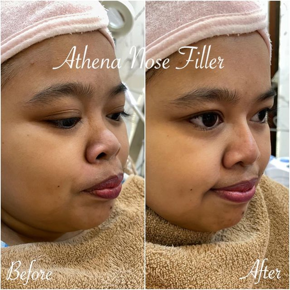 Penampilan Kekeyi Setelah Filler Hidung