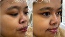 Penampilan Kekeyi Setelah Filler Hidung Penampilan Kekeyi Setelah Filler Hidung