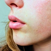 Pelajari 5 Cara Memperbaiki Skin Peeling yang Home-Friendly