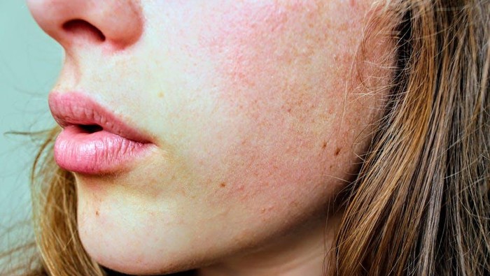 Pelajari 5 Cara Memperbaiki Skin Peeling yang Home-Friendly Pelajari 5 Cara Memperbaiki Skin Peeling yang Home-Friendly
