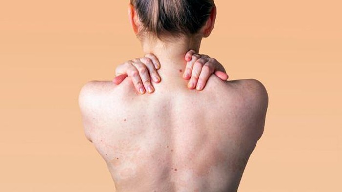 7 Cara Mudah Mengatasi Jerawat di Punggung