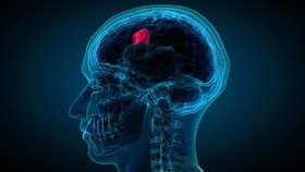 Mayapada Hospital Bandung Sukses Operasi Tumor Otak Minimal Invasif